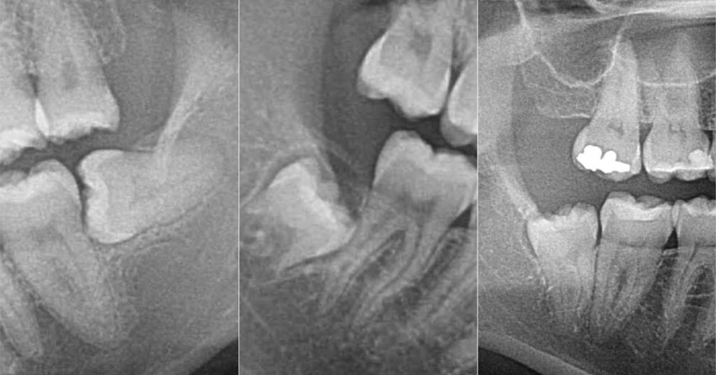 Fino A Che Età Escono I Denti Del Giudizio